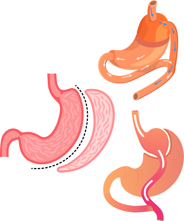Sleeve Gastrectomy Illustration