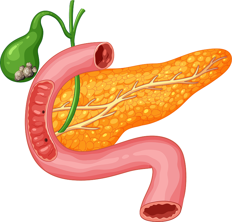 Sleeve Gastrectomy Illustration