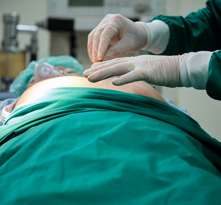 Sleeve Gastrectomy Surgery