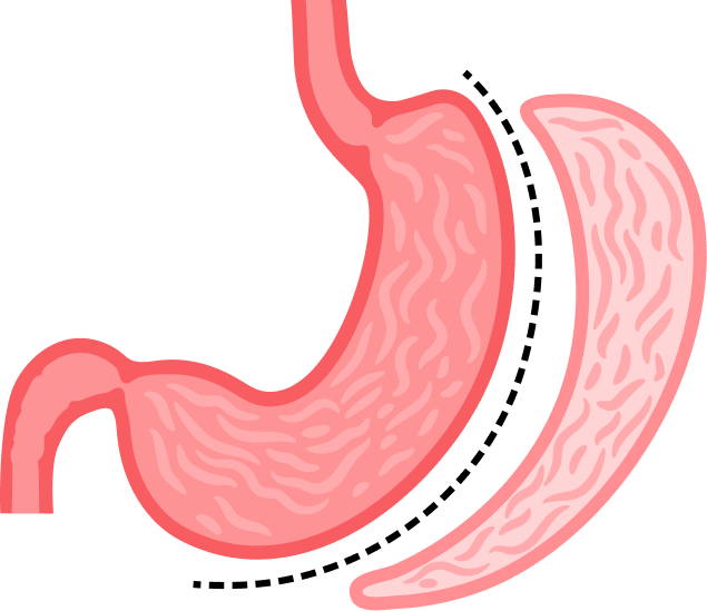Sleeve Gastrectomy Illustration