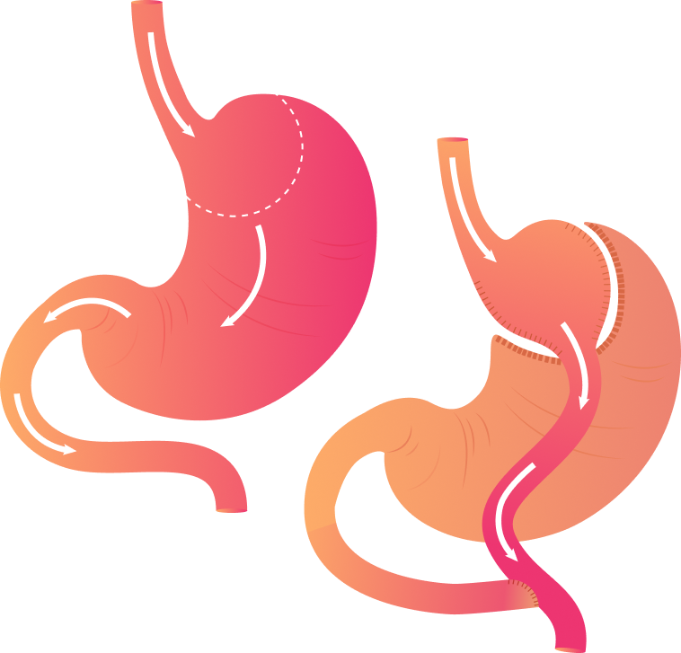 Sleeve Gastrectomy Illustration