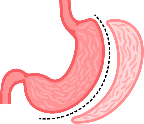 Sleeve Gastrectomy Illustration