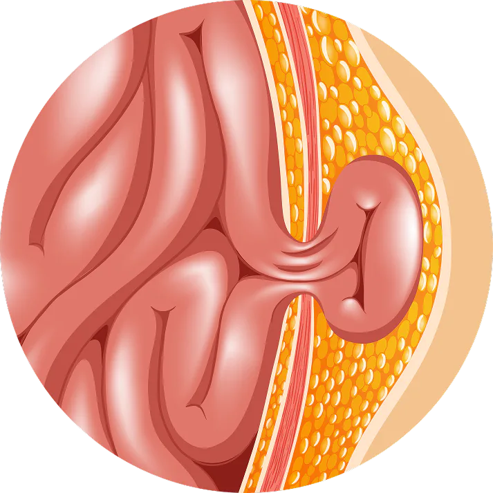 Sleeve Gastrectomy Illustration