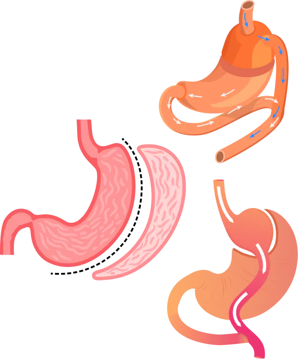 Sleeve Gastrectomy Illustration