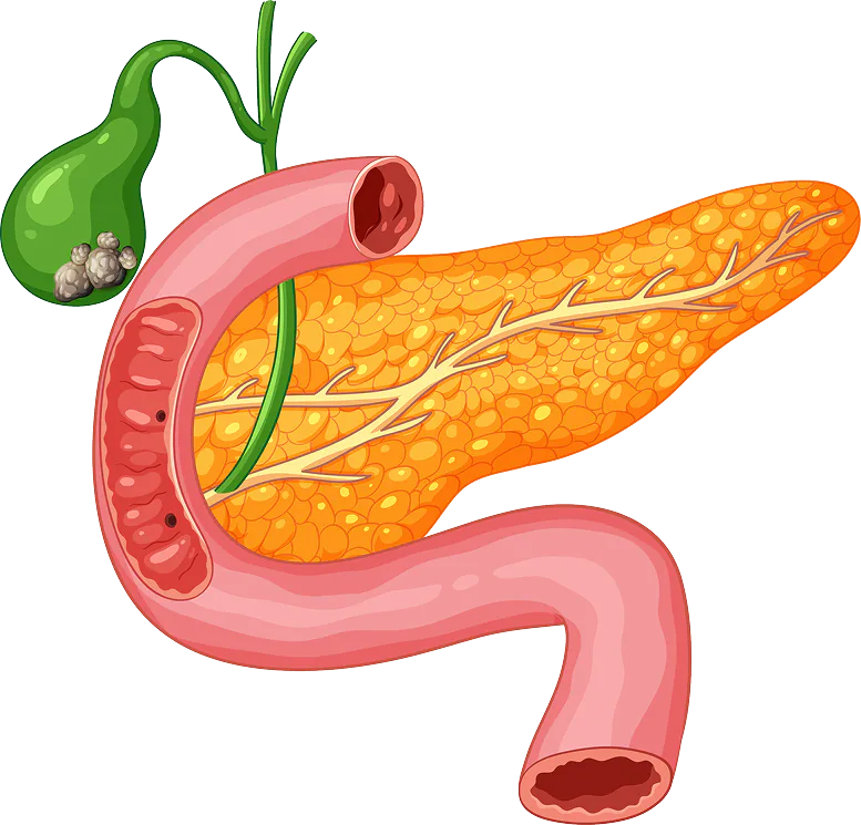 Sleeve Gastrectomy Illustration