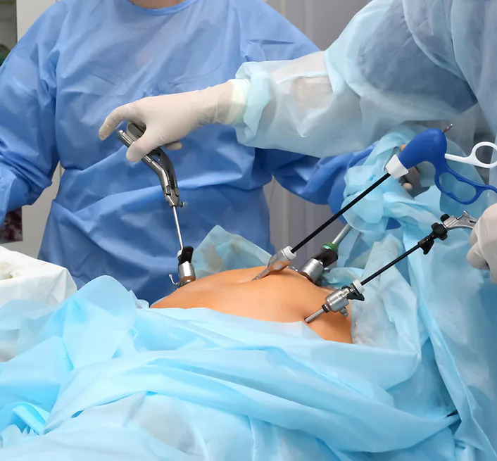 Sleeve Gastrectomy Surgery