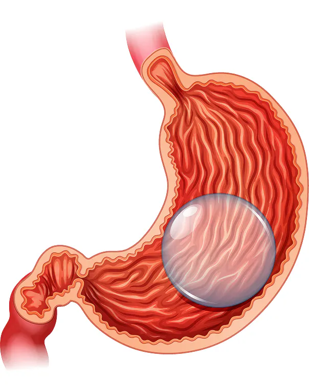 Sleeve Gastrectomy Illustration