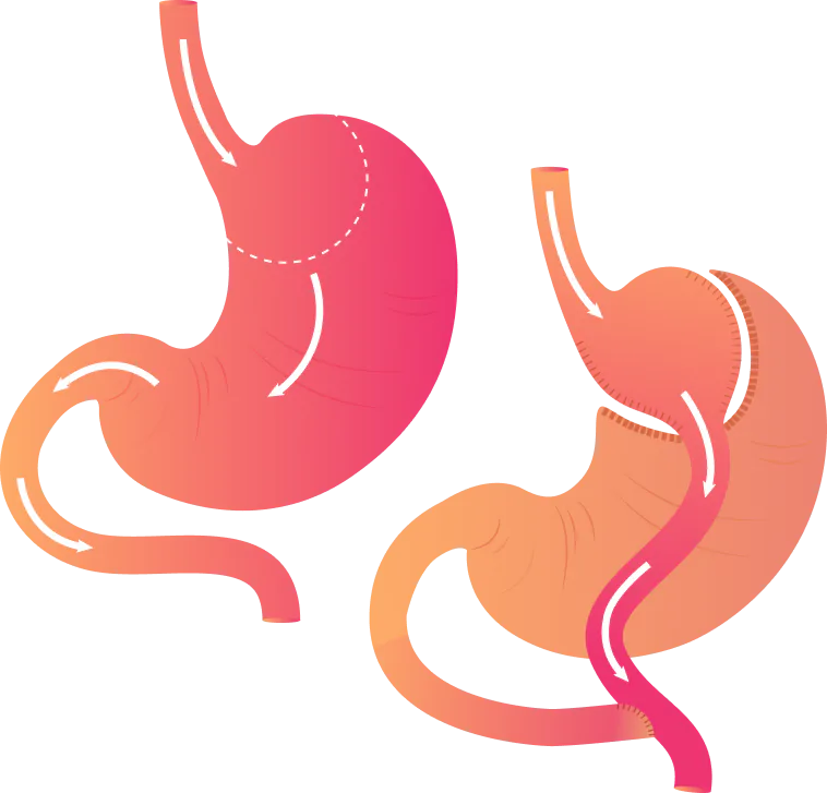 Sleeve Gastrectomy Illustration
