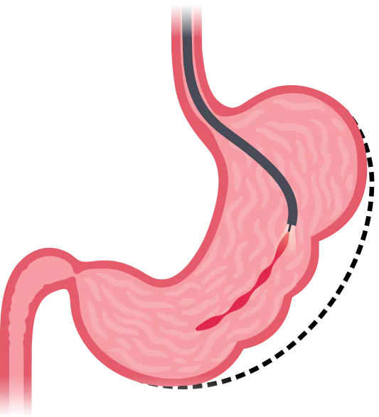 Stomach Tightening