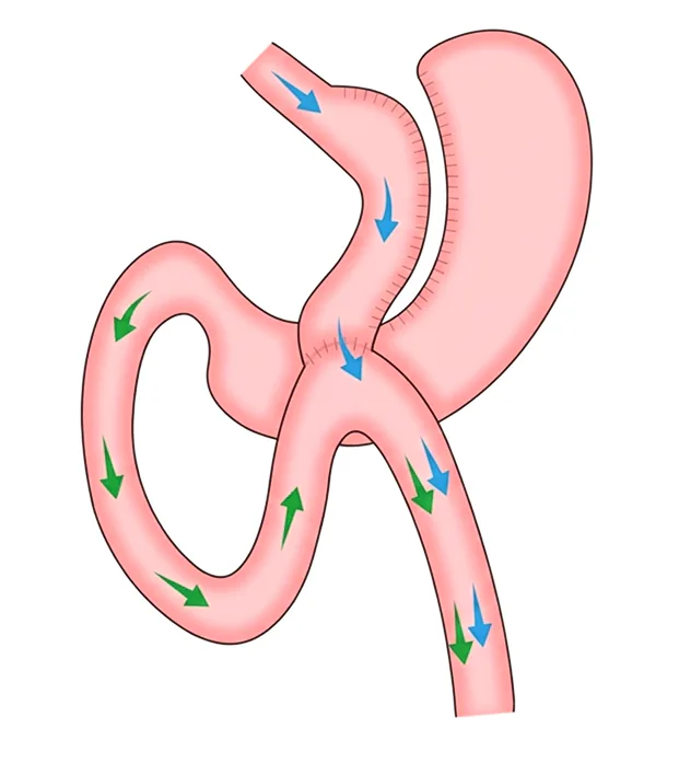 Sleeve Gastrectomy Illustration