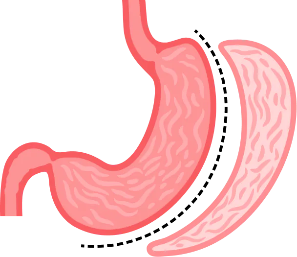 Sleeve Gastrectomy Illustration